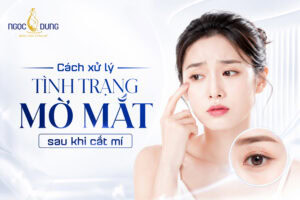 Mờ mắt sau khi cắt mí