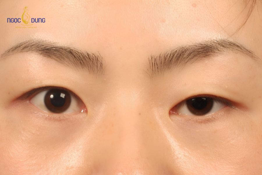 Biểu hiện bất đối xứng nếp mí khi một bên rõ nét, bên còn lại bị hẹp nhỏ hoặc lờ đờ