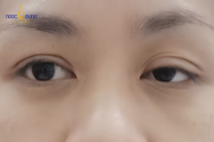 Bờ mi trên hạ thấp che phủ đồng tử là dấu hiệu điển hình của biến chứng sụp mí