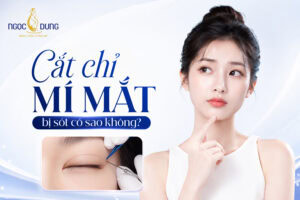 Cắt chỉ mí mắt bị sót
