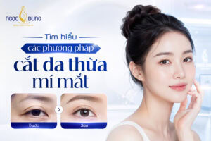 Cắt da thừa mí mắt