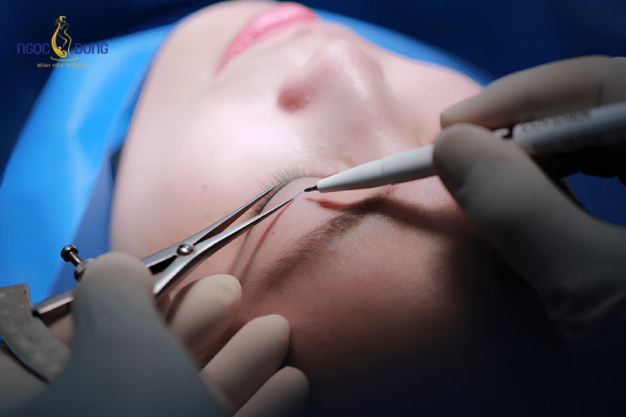 Phẫu thuật cắt mí Mini Deep: Thông tin cần biết từ A - Z 12 Cắt mí Mini Deep là giải pháp lý tưởng cho người trẻ tuổi sở hữu đôi mắt một mí, mí lót