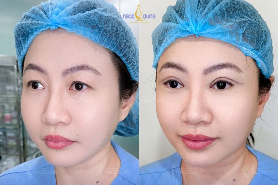 Phẫu thuật cắt mí full: Thông tin cần biết từ A - Z 10 Chi phí trọn gói minh bạch đi kèm chất lượng dịch vụ chuẩn y khoa tại BVTM Ngọc Dung