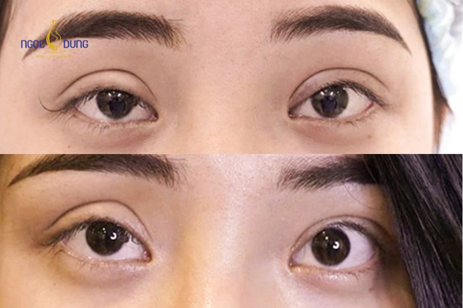 Cắt mí mắt bị trợn: Nguyên nhân và cách khắc phục hiệu quả 6 Chứng hở mi khiến hai bờ mi không thể khép kín khi mắt ở trạng thái nhắm chủ động