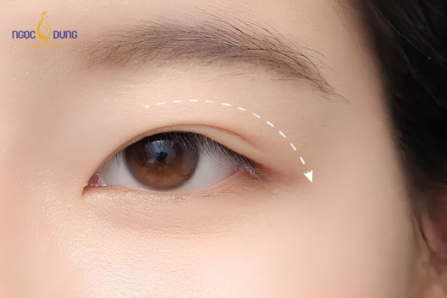 5 phương pháp cắt mí đẹp, thông dụng hiện nay 18 Dao Plasma hiện đại hỗ trợ khóa mạch máu nhanh, giảm sưng bầm và giúp vết mổ nhanh gom form