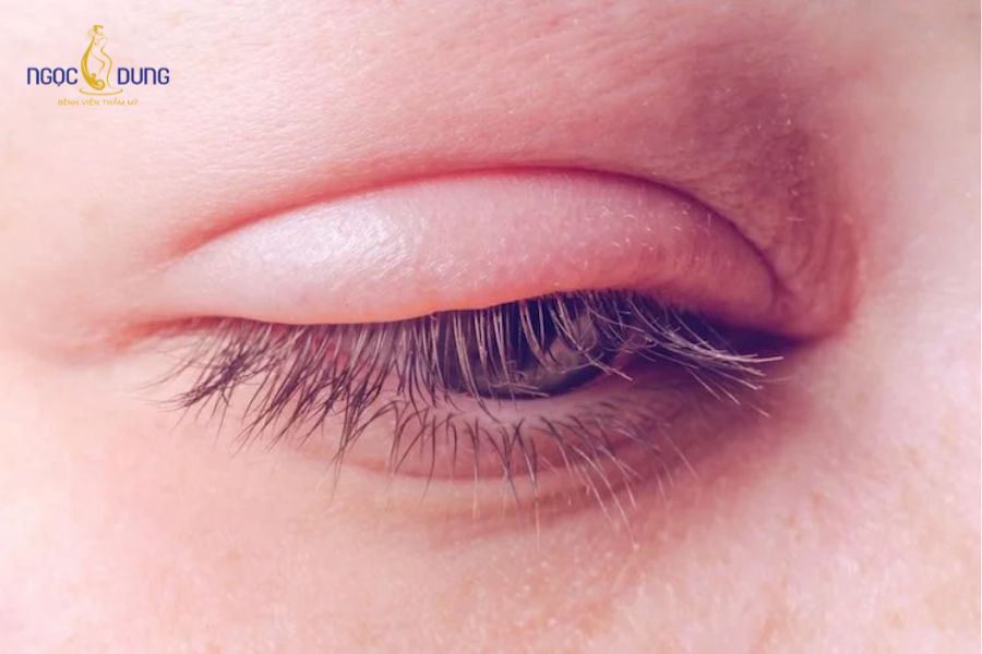 Cắt mí có ảnh hưởng tới thị lực không? Mờ mắt sau khi cắt mí 14 Đến gặp bác sĩ ngay nếu mắt có dấu hiệu đau nhức sâu hoặc sưng bầm bất thường