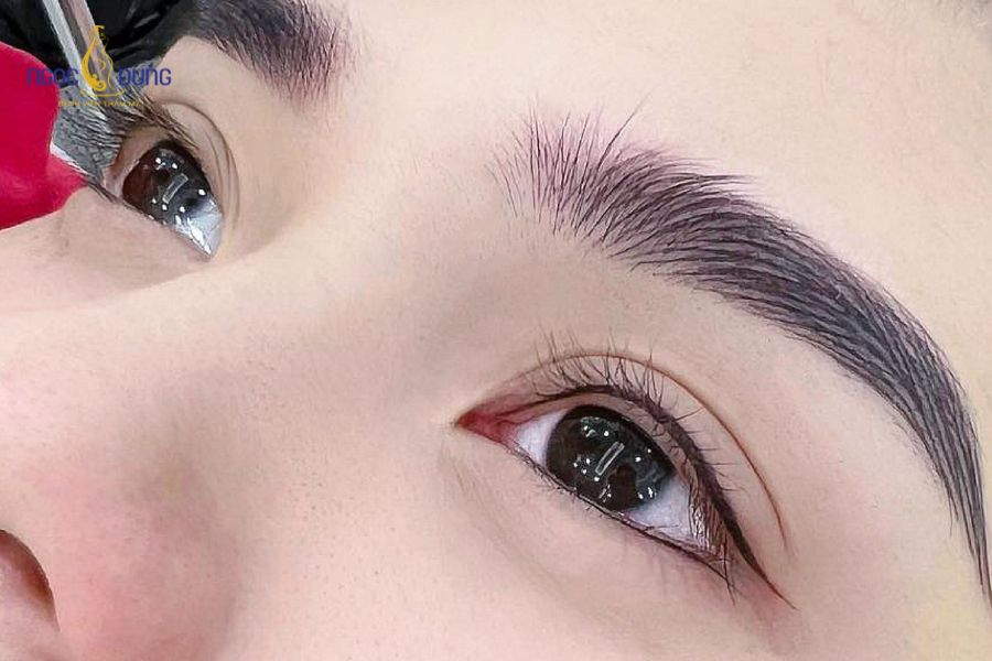 Phẫu thuật cắt mí Mini Deep: Thông tin cần biết từ A - Z 11 Đường rạch siêu nhỏ ở trung tâm mi mắt loại bỏ mỡ thừa mà không cần can thiệp toàn phần