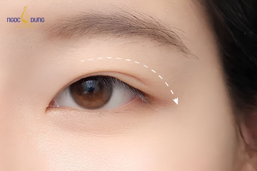 Phẫu thuật cắt da thừa mí mắt: Thông tin cần biết từ A–Z 8 Hiện tượng da chùng, bọng mỡ xuất hiện quanh mắt do ảnh hưởng của quá trình lão hóa tự nhiên