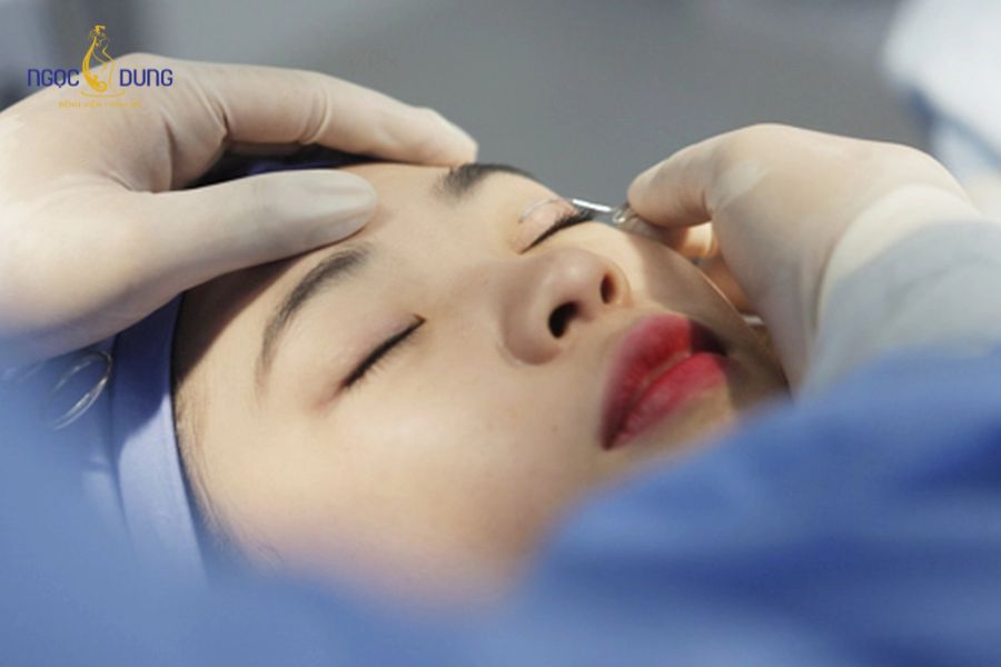 Cắt mí mắt bị sâu: Dấu hiệu, nguyên nhân và cách sửa mí 11 Khả năng khắc phục mí sâu phụ thuộc vào mức độ sẹo xơ và tay nghề của bác sĩ phẫu thuật
