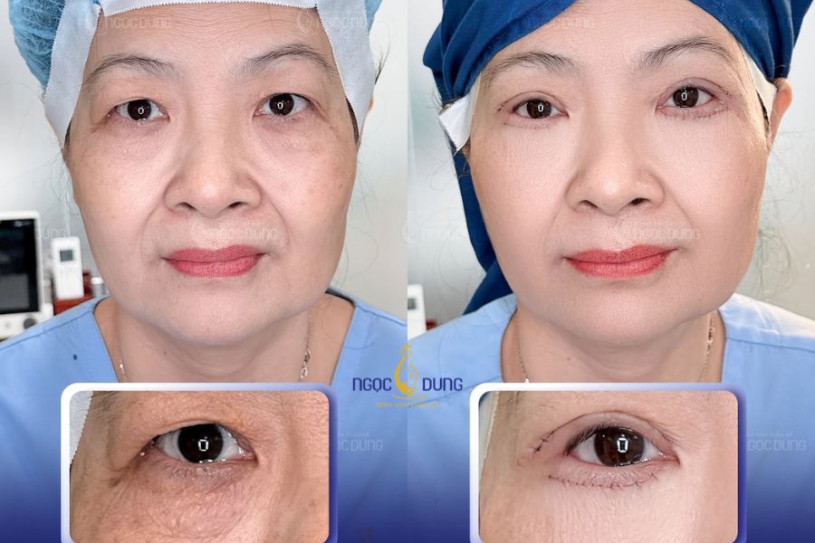 Cắt mí mắt có được vĩnh viễn không? Biến chứng khi về già 6 Khách hàng có thể thực hiện tái phẫu thuật khi vùng mi mắt có hiện tượng sụp xệ do tuổi tác