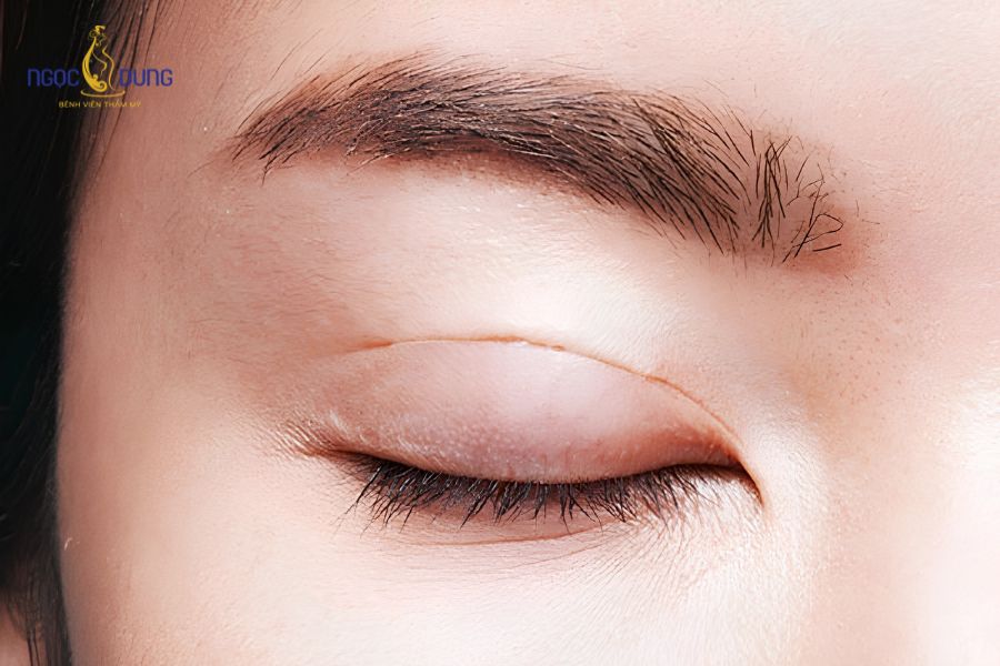 Cắt mí mắt có ăn được thịt dê không? Nên kiêng bao lâu? 10 Khách hàng nên chủ động kiêng thịt dê từ 3 đến 4 tuần để đảm bảo vạt da mí được chữa lành an toàn