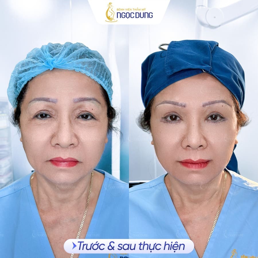 Cấy mỡ hốc mắt giá bao nhiêu? Ưu điểm của phương pháp 14 Khách hàng tin chọn Bệnh viện Thẩm mỹ Ngọc Dung để trải nghiệm dịch vụ trẻ hóa mắt chuẩn 5 sao