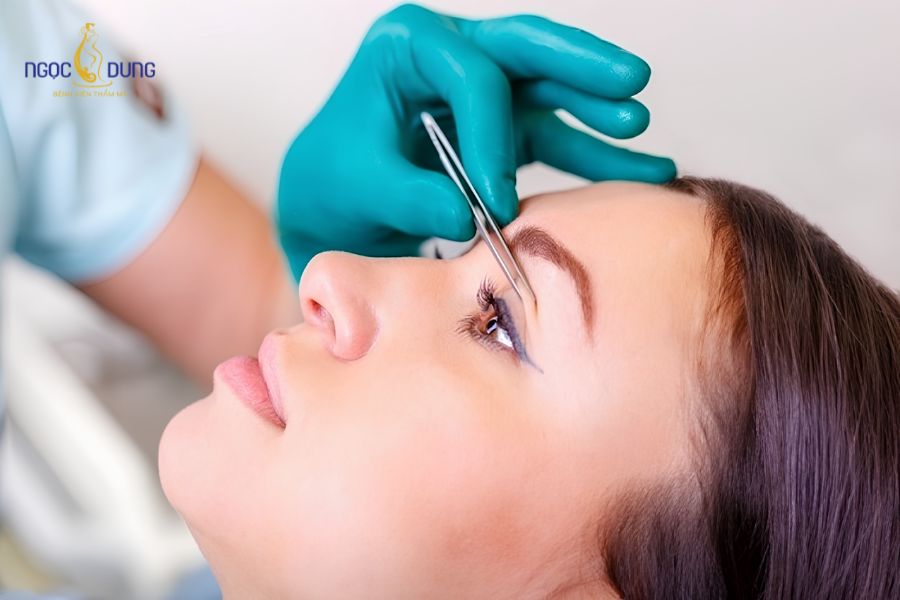 5 phương pháp cắt mí đẹp, thông dụng hiện nay 16 Kỹ thuật khâu giấu chỉ dưới da giúp nếp mí hình thành mềm mại, hạn chế tối đa dấu vết thẩm mỹ