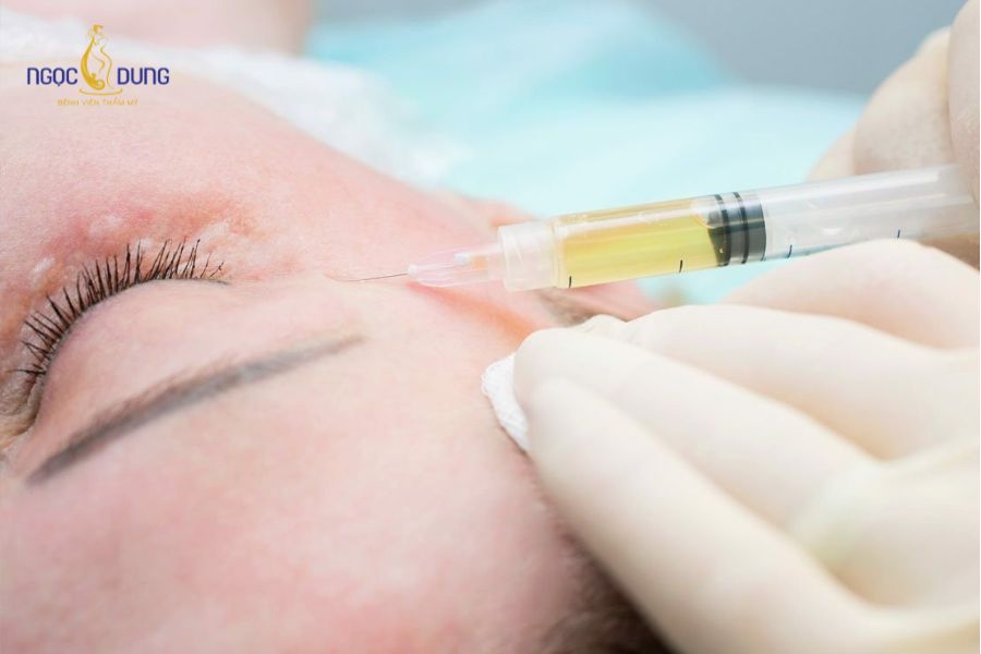 Cấy mỡ hốc mắt giá bao nhiêu? Ưu điểm của phương pháp 11 Làm đầy hốc mắt bằng mỡ tự thân mang lại độ tương thích tối ưu và vẻ đẹp mềm mại tự nhiên