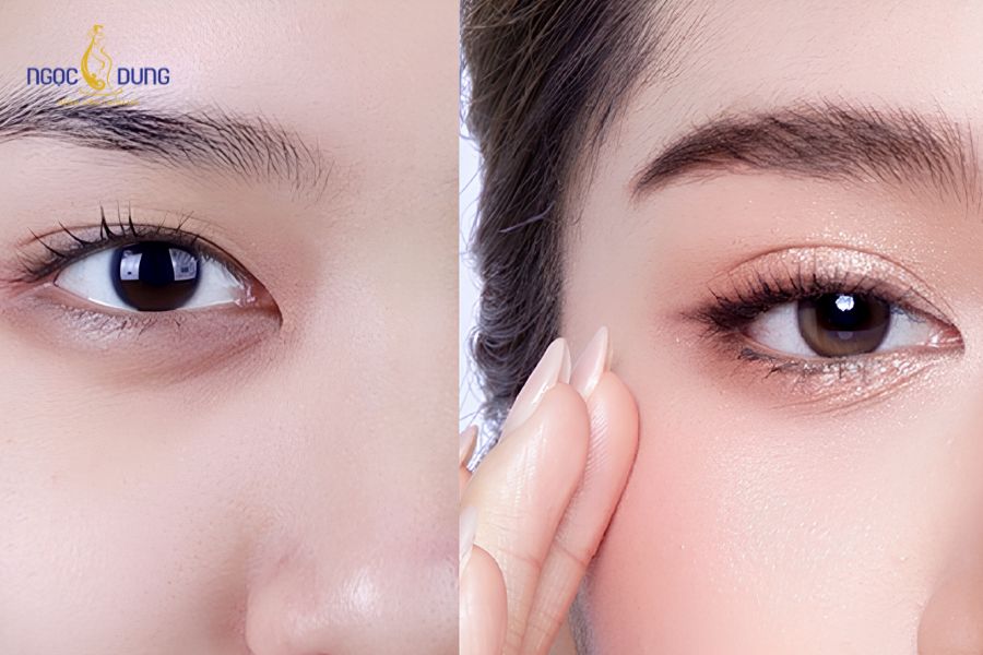Phẫu thuật cắt da thừa mí mắt: Thông tin cần biết từ A–Z 12 Lựa chọn cơ sở uy tín giúp giảm thiểu các rủi ro như lật mi hay nếp mí không đều nhau