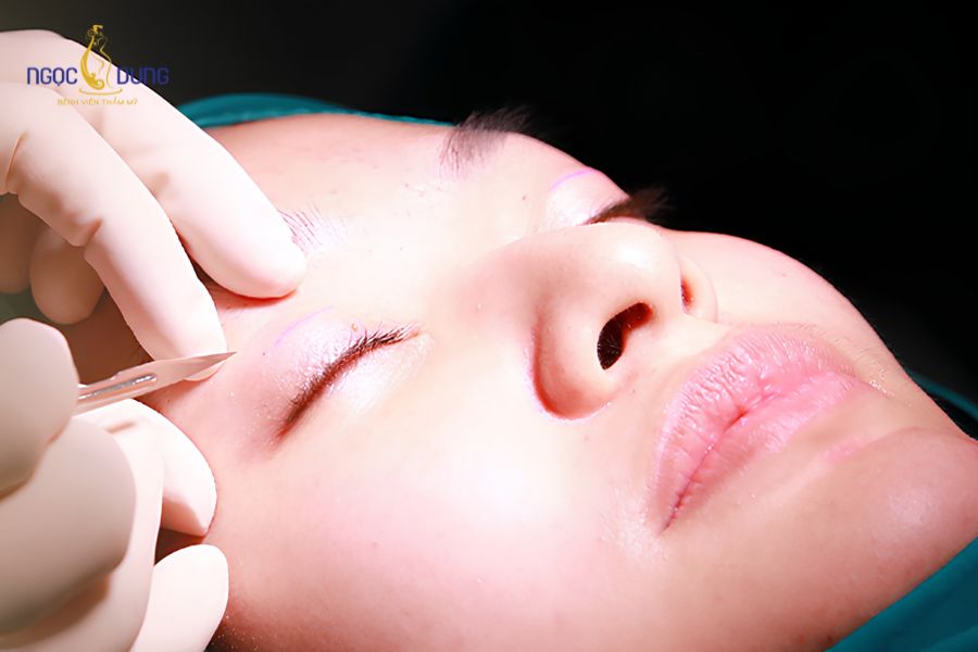 Cắt chỉ mí mắt sau mấy ngày? Cách giảm đau mí mắt sau khi cắt chỉ 11 Mép vết thương khép khít và không còn rỉ dịch là điều kiện cần thiết để tiến hành tháo chỉ