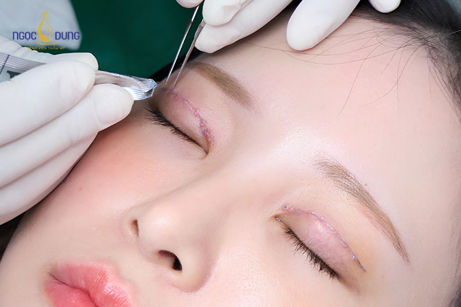 Mốc thời gian cắt chỉ thông thường dao động từ 5 đến 7 ngày tùy thuộc vào tốc độ hồi phục của cơ thể