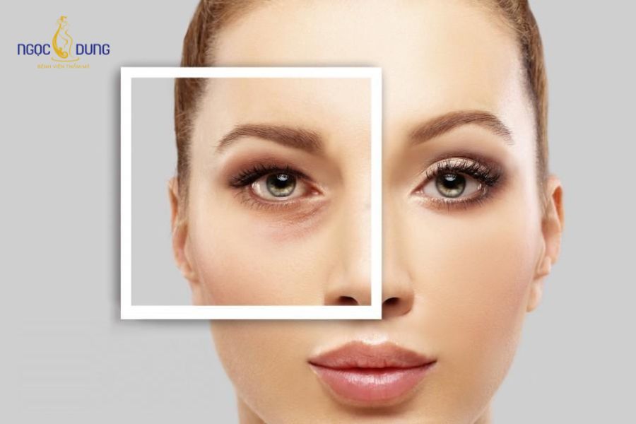 Phẫu thuật cắt da thừa mí mắt: Thông tin cần biết từ A–Z 10 Những trường hợp mắt bị sụp mí, có nhiều da chùng nên cân nhắc thực hiện cắt da thừa mí mắt