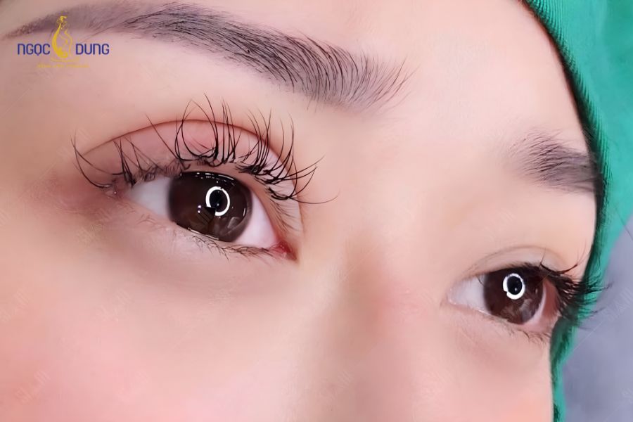 Cắt mí có ảnh hưởng tới thị lực không? Mờ mắt sau khi cắt mí 12 Phản ứng sưng nề tự nhiên của mô kẽ là nguyên nhân phổ biến gây mờ mắt tạm thời