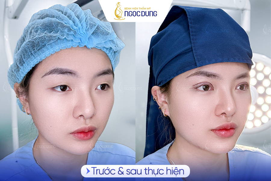 Cắt chỉ mí mắt bị sót có sao không? Cần đi bệnh viện không? 14 Quy trình cắt chỉ an toàn, nhẹ nhàng và chuẩn y khoa tại Bệnh viện Thẩm mỹ Ngọc Dung