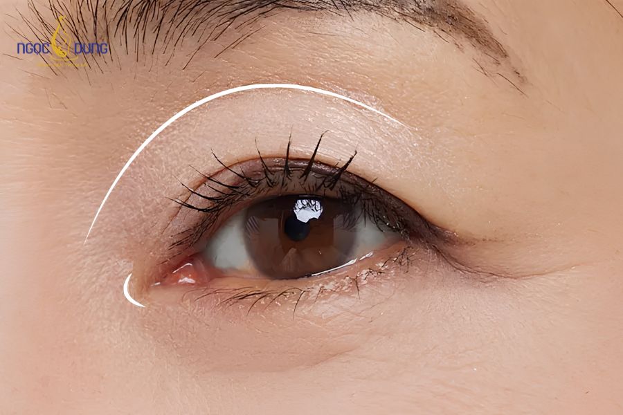 Cắt mí mắt bị sâu: Dấu hiệu, nguyên nhân và cách sửa mí 12 Sai sót kỹ thuật khi bóc tách quá mức mô mỡ tự nhiên là nguyên nhân gây lõm hốc mắt