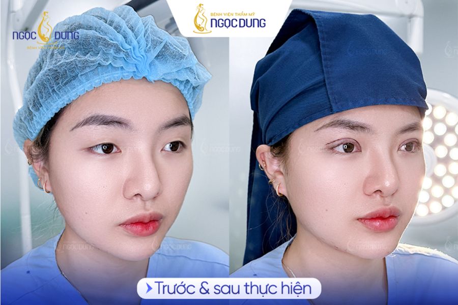 Nhấn mí mắt bao nhiêu tiền? Bảng giá tại Bệnh Viện Ngọc Dung 18 Sở hữu đôi mắt 2 mí long lanh, rạng rỡ tại Bệnh viện Thẩm mỹ Ngọc Dung