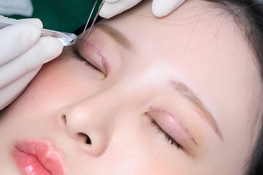 Sợi chỉ sót lại vùng mí mắt tuy không nguy hiểm trực tiếp đến thị lực nhưng cần được xử lý sớm