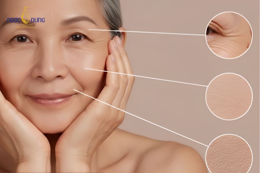 2 mí mắt không đều phải làm sao? Nguyên nhân và cách khắc phục 12 Sự sụt giảm collagen sau tuổi 30 khiến da chùng và mỡ thừa tích tụ không đồng đều giữa hai bên mắt