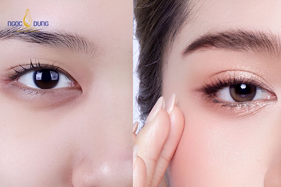 Cắt mí có ảnh hưởng tới thị lực không? Mờ mắt sau khi cắt mí 11 Tầm nhìn bị nhòe hoặc có màng sương mỏng thường chỉ là phản ứng tạm thời sau hậu phẫu