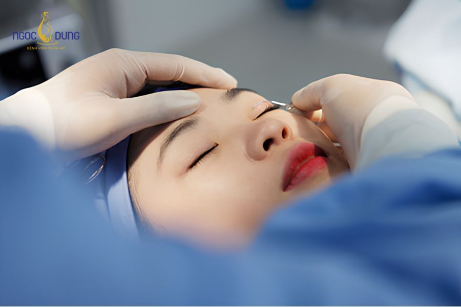 Cắt mí kiêng ăn ốc bao lâu? Có ăn được ốc không? 5 Thời gian kiêng cữ được phân chia theo từng giai đoạn lành thương sinh học của vùng mắt