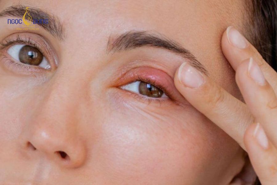 Cắt mí mắt có được vĩnh viễn không? Biến chứng khi về già 7 Thực hiện cắt mí tại các cơ sở không uy tín dễ dẫn đến nguy cơ trợn mắt hoặc lộ sẹo xơ co rút