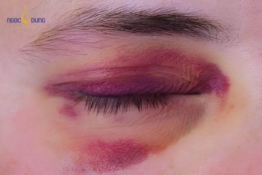 Cắt mí mắt bị thâm: Nguyên nhân và cách cải thiện sau khi cắt mí 9 Tổn thương hệ thống vi mạch dưới da trong quá trình phẫu thuật là nguyên nhân chính gây tụ máu bầm