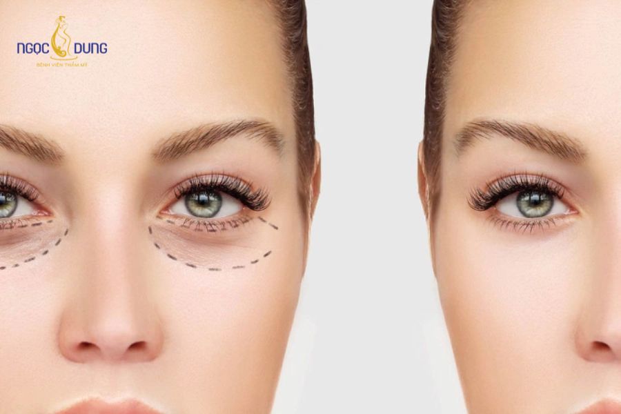 Phẫu thuật cắt mí mắt dưới giá bao nhiêu? Yếu tố ảnh hưởng 12 Tùy thuộc vào khuyết điểm vùng mi dưới, bác sĩ sẽ chỉ định phương pháp can thiệp phù hợp