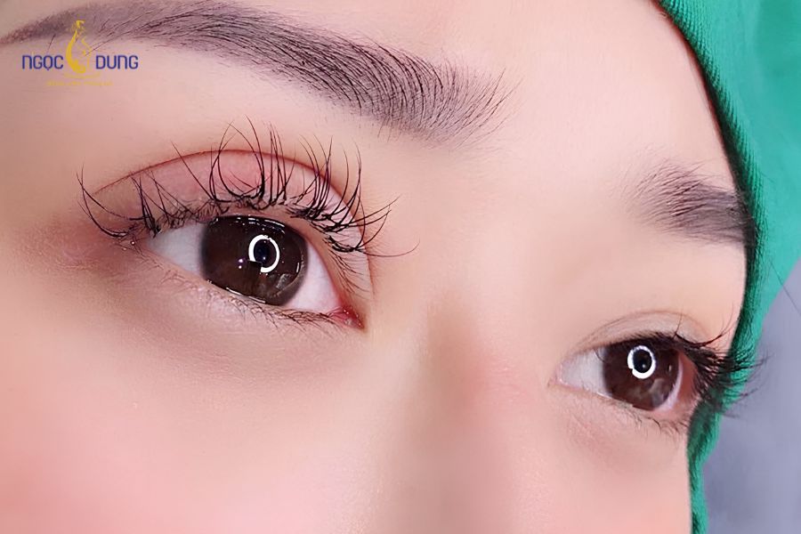 Cắt mí mắt bị trợn: Nguyên nhân và cách khắc phục hiệu quả 7 Việc cắt bỏ lượng da thừa vượt quá tỷ lệ an toàn dễ khiến mi mắt bị kéo căng quá mức
