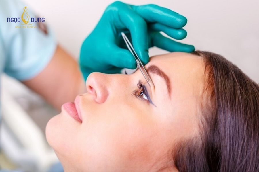 Cắt mí không nhắm được mắt: Nguyên nhân & cách khắc phục 10 Việc loại bỏ lượng da mi vượt quá tỷ lệ an toàn dễ dẫn đến hiện tượng co rút chiều dọc mí mắt