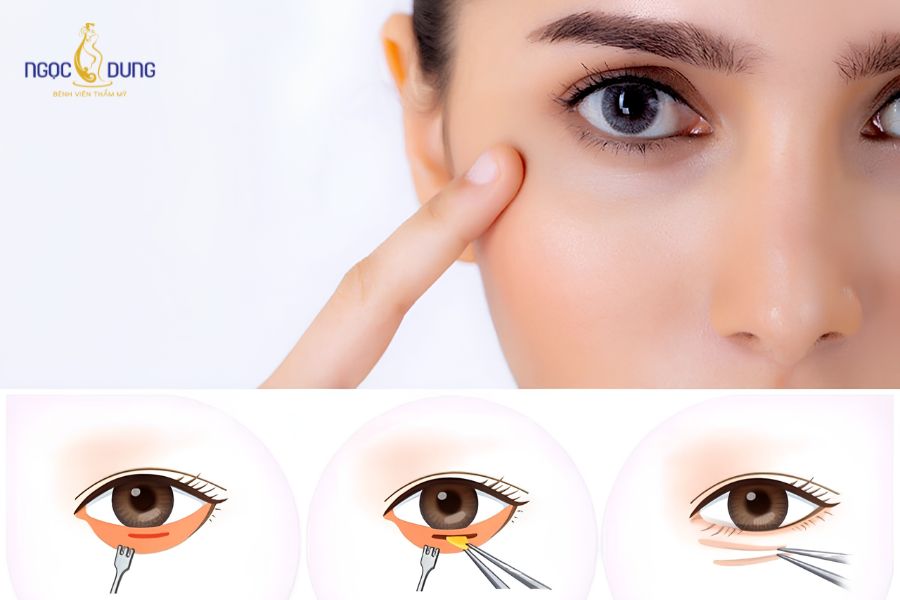 Phẫu thuật cắt mí mắt dưới