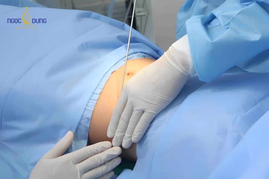 Dịch vụ hút mỡ 1 vùng bụng dưới an toàn tại Ngọc Dung 18 Bác sĩ bơm dung dịch tumescent hỗ trợ làm loãng khối mỡ bụng dưới khi hút mỡ 1 vùng bụng dưới