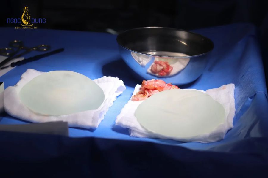 Nâng ngực bao lâu phải tháo ra? Dấu hiệu và cách xử lý 11 Bác sĩ chuyên khoa kiểm tra mức độ co thắt bao xơ để đưa ra phương án xử lý thích hợp