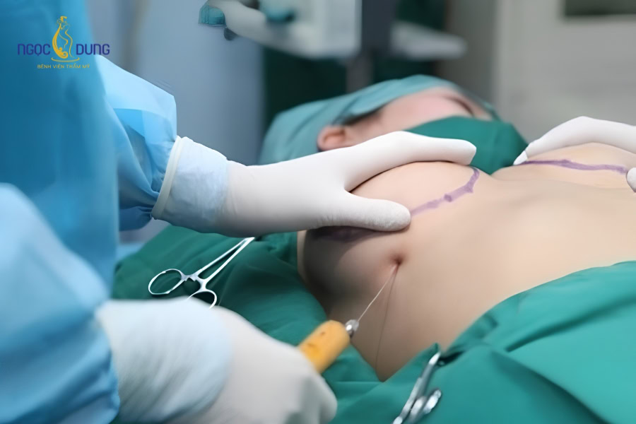 Cấy mỡ vùng ngực: Nâng ngực tự thân chuẩn y khoa uy tín 11 Bác sĩ chuyên khoa sâu đo đạc và phác thảo lượng mỡ dự trữ tại vùng bụng đùi