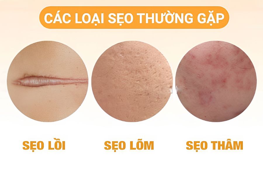 Phẫu thuật cắt sửa sẹo xấu: Các phương pháp và Quy trình 10 Bác sĩ sẽ phân loại các hình thái sẹo xấu trước khi điều trị