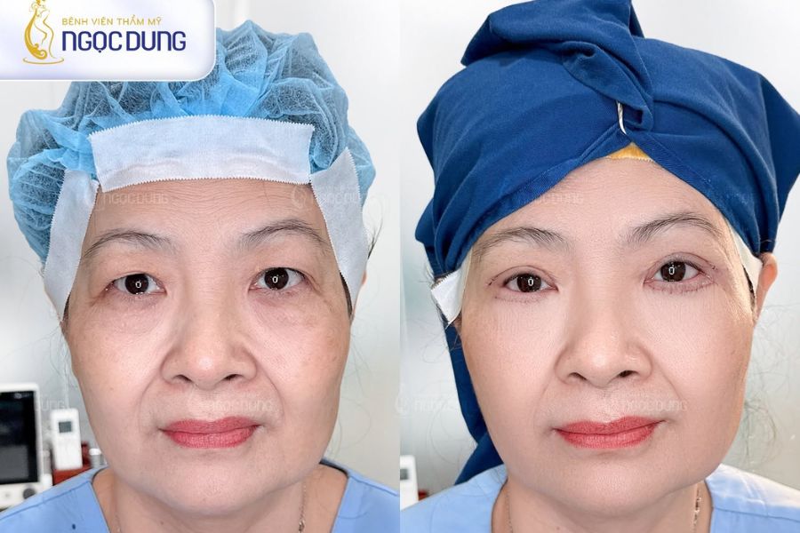 Cắt mí bao nhiêu tiền? Tổng hợp bảng giá dịch vụ cắt mí mắt 10 Bác sĩ tiến hành bóc tách, giải phóng mô sẹo cũ để tái tạo lại dáng mí hỏng