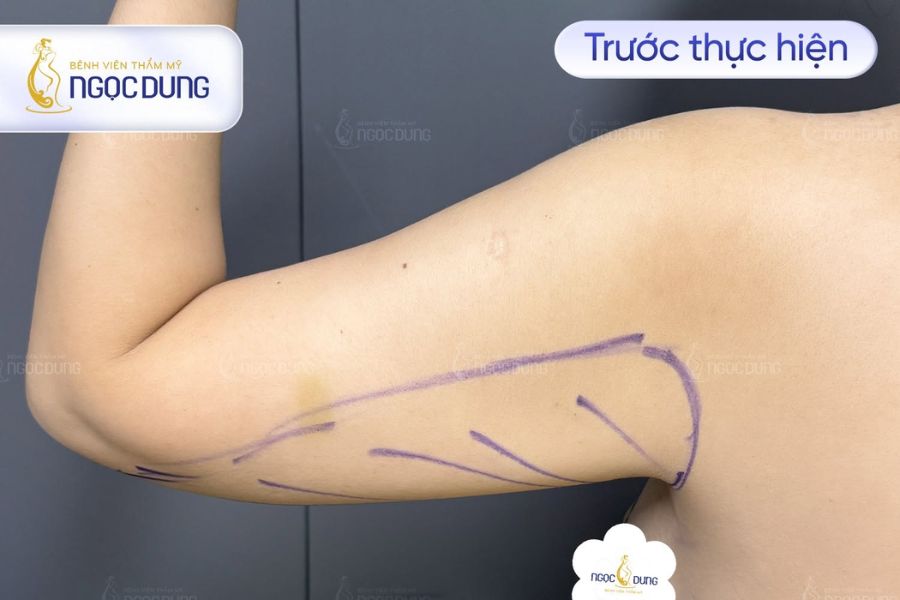 Cắt da thừa vùng nách: Quy trình, chi phí và an toàn 11 Bác sĩ tiến hành kiểm tra mức độ đàn hồi và cấu trúc mô mỡ dưới nách