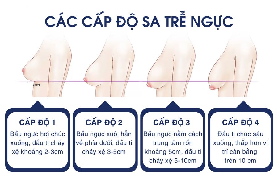 Nâng ngực sa trễ: Phân loại, phương pháp và bảng giá 16 Bốn cấp độ ngực sa trễ dựa trên khoảng cách thả xệ của núm vú so với chân ngực