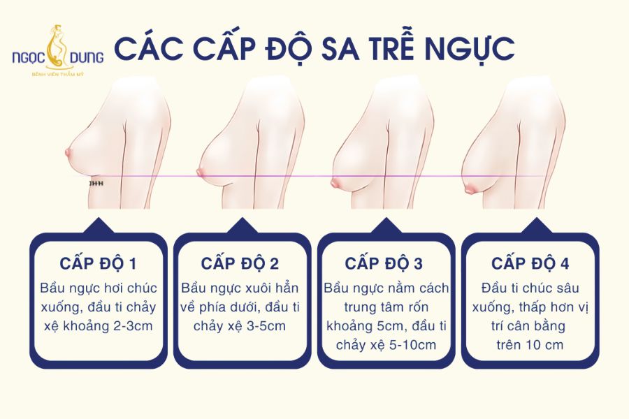 Treo ngực xệ, to giá bao nhiêu? Cấp độ và quy trình 16 Các cấp độ sa trễ của ngực to, xệ trong thẩm mỹ