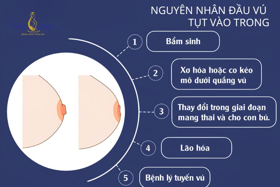 Phẫu thuật kéo núm vú tụt: Bảng giá, quy trình 2026 14 Các nguyên nhân phổ biến gây nên tình trạng tụt núm vú vào trong