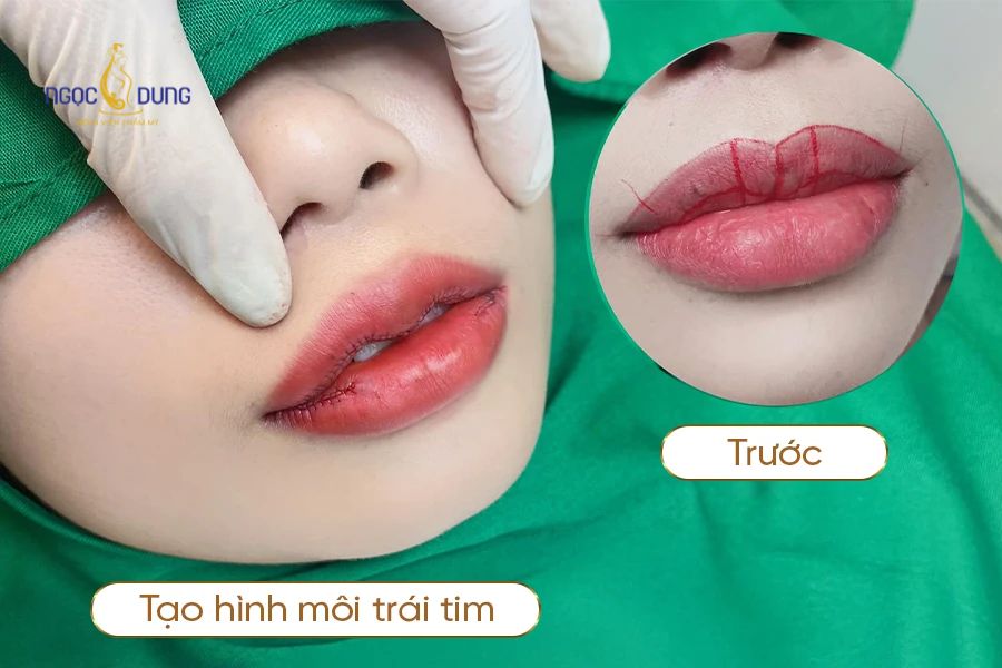 Dịch vụ phẫu thuật tạo hình môi đẹp chuẩn hóa ở Ngọc Dung 8 Các phương pháp tạo hình dáng môi phổ biến tại bệnh viện