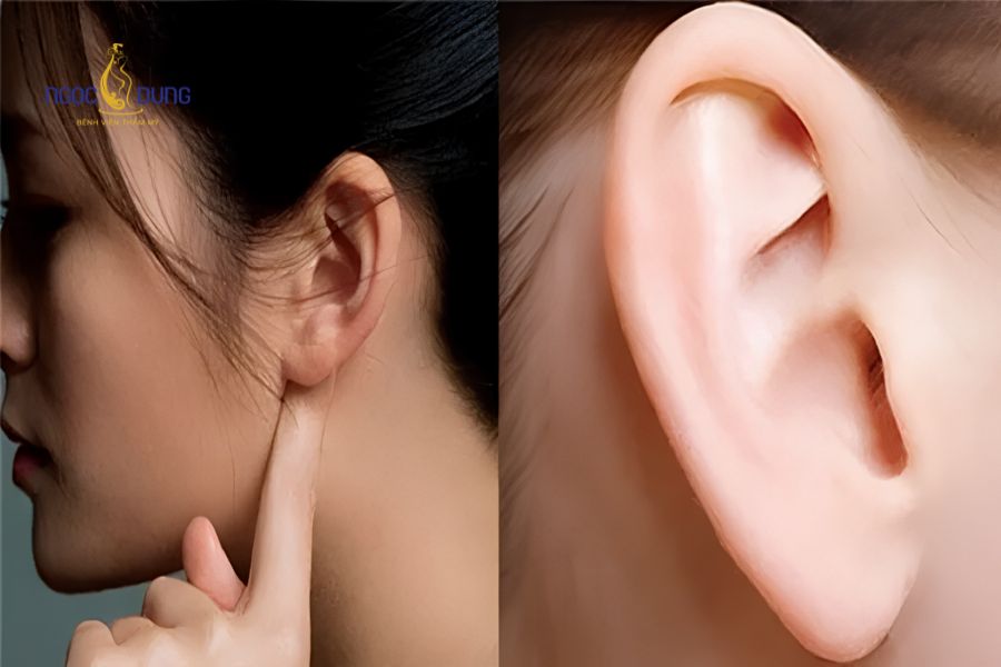 Chỉnh hình dái tai: Phương pháp, quy trình và bảng giá 8 Các tình trạng dái tai mỏng hóp hoặc tổn thương cần khắc phục