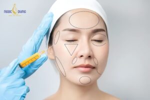 Các vị trí chỉ định cấy mỡ đơn lẻ phổ biến như thái dương, rãnh cười và hốc mắt