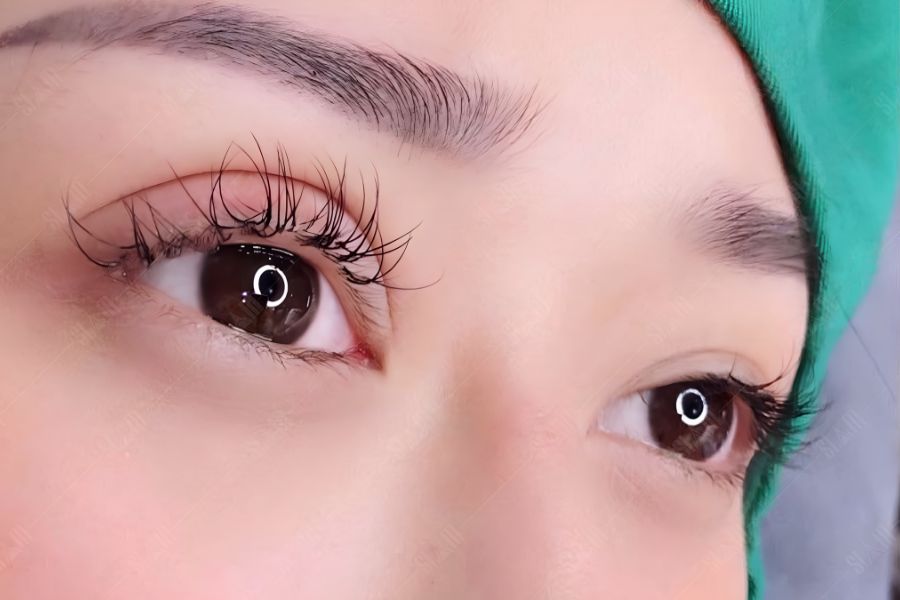 Cấy mỡ mí trên là gì? Chi phí, quy trình và địa chỉ uy tín 10 Cách Chăm Sóc Sau Khi Cấy Mỡ Mí Trên Giúp Nhanh Hồi Phục