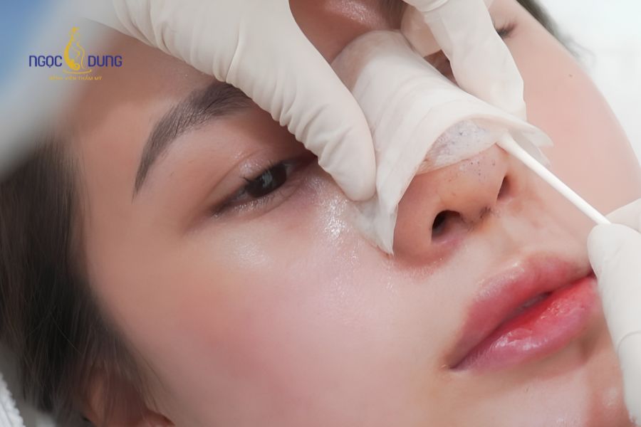 Nâng mũi sụn sườn: Ưu nhược điểm, bảng giá và quy trình 11 Cách vệ sinh và bảo vệ vết thương vùng mũi sau khi thực hiện phẫu thuật